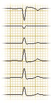 EKG-Kurve